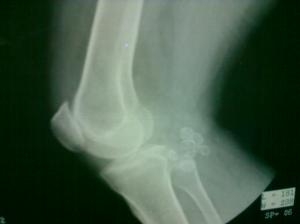 X_RAY_-_Knee